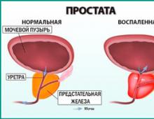 Виды простатита в разнообразии форм и типов течения болезни