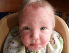 Чем снять неприятный зуд при аллергии у ребенка — какие лекарства и народные средства используют в домашних условиях?