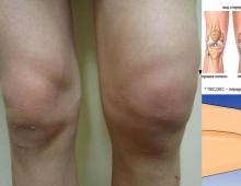 Стадии и лечение остеоартроза коленного сустава Доа коленного сустава 3 степени что